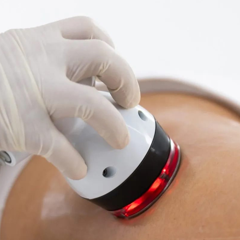 Forma Body - Radiofrequenza cono